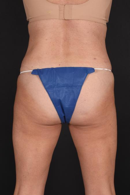 After image 4 Case #133651 - Abdominoplasty