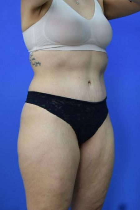 After image 2 Case #134256 - Drainless Tummy Tuck