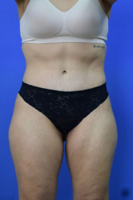 After image 1 Case #134256 - Drainless Tummy Tuck