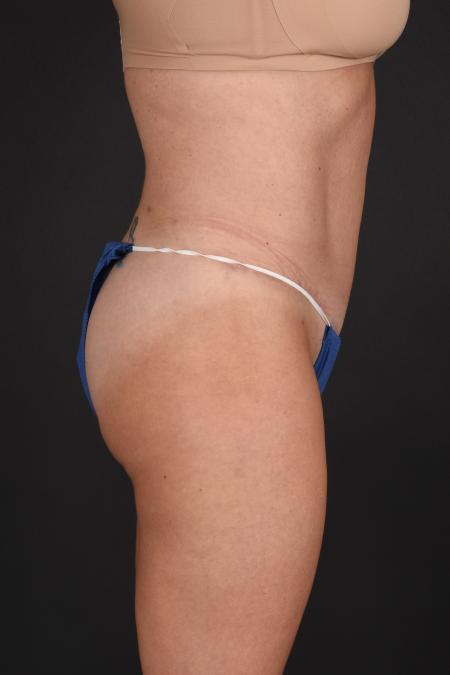 After image 3 Case #133651 - Abdominoplasty