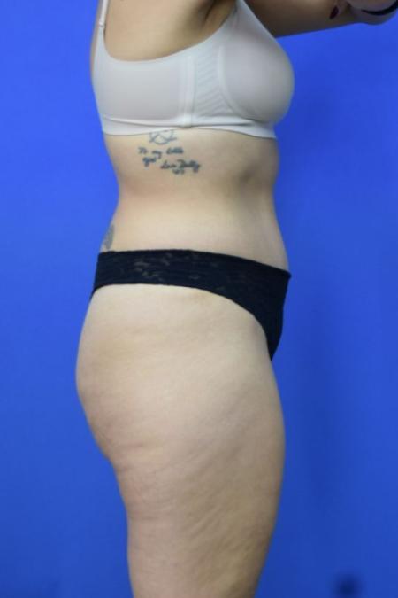After image 3 Case #134256 - Drainless Tummy Tuck