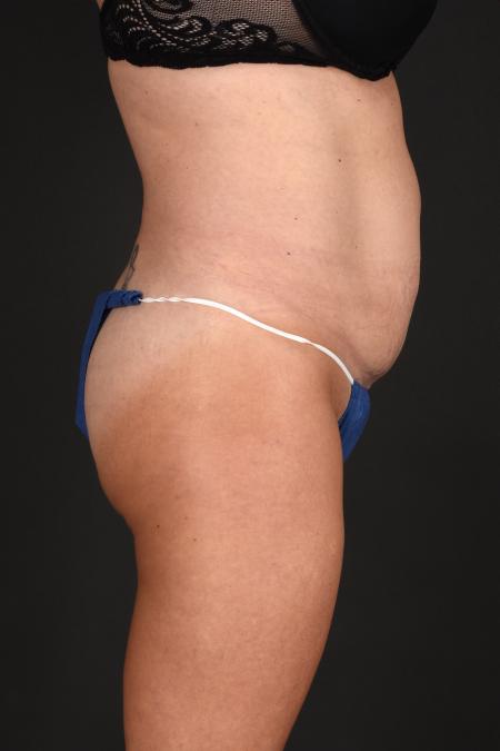 Before image 3 Case #133651 - Abdominoplasty
