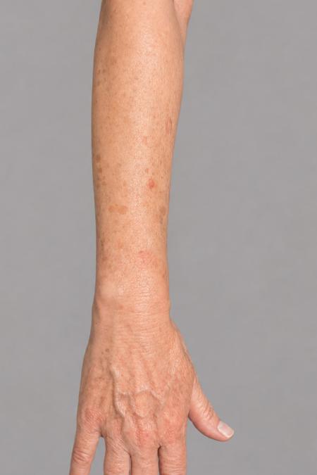 Before image 1 Case #133646 - 66 y.o. female with IPL to arms