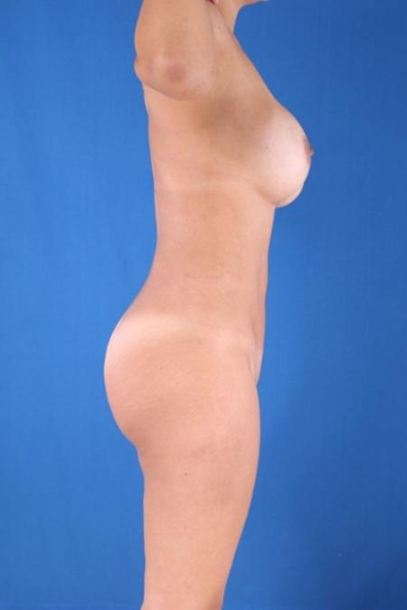 After image 3 Case #134866 - Liposculpture