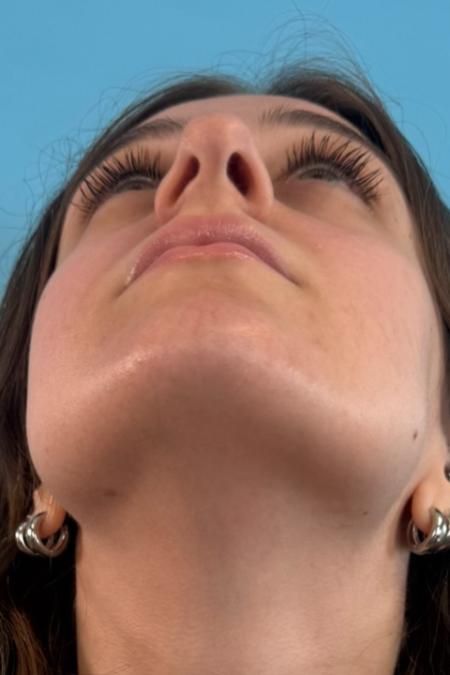 Before image 6 Case #134751 - Rhinoplasty & Septoplasty - 1 year postop