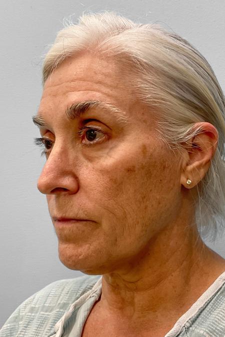 Before image 2 Case #134841 - Facial Rejuvenation