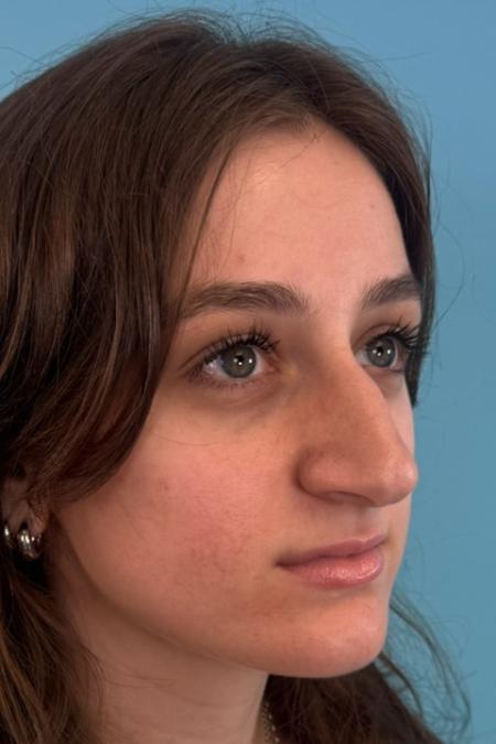 Before image 4 Case #134751 - Rhinoplasty & Septoplasty - 1 year postop