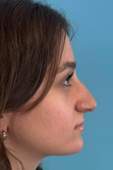 Before image 5 Case #134751 - Rhinoplasty & Septoplasty - 1 year postop