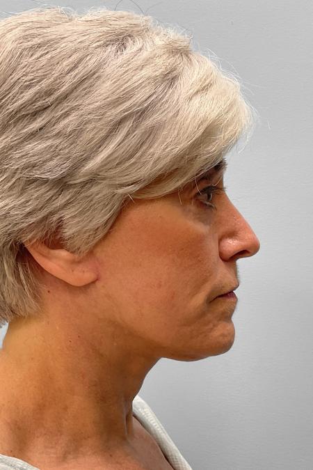 After image 3 Case #134841 - Facial Rejuvenation