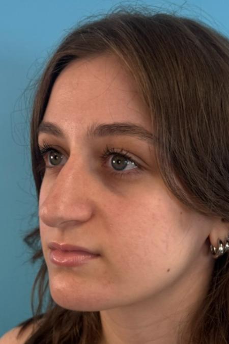 Before image 2 Case #134751 - Rhinoplasty & Septoplasty - 1 year postop