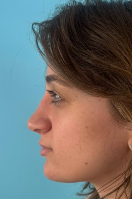 After image 3 Case #134751 - Rhinoplasty & Septoplasty - 1 year postop