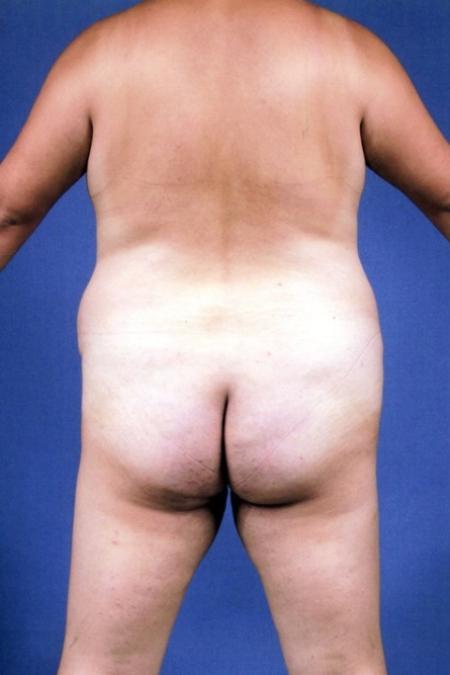 Before image 5 Case #134271 - Abdominoplasty plus Lipoesculpture