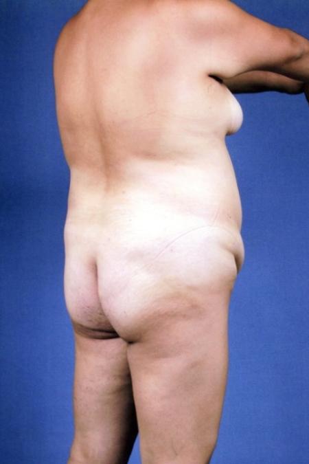 Before image 4 Case #134271 - Abdominoplasty plus Lipoesculpture