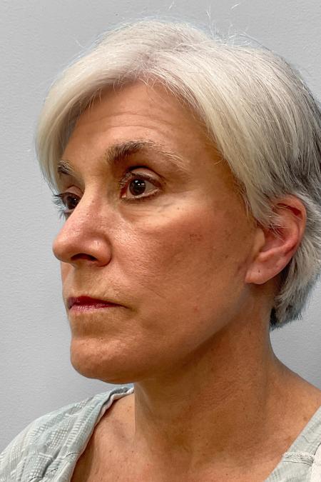 After image 2 Case #134841 - Facial Rejuvenation