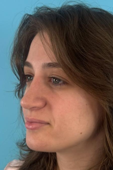 After image 2 Case #134751 - Rhinoplasty & Septoplasty - 1 year postop