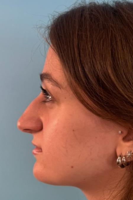 Before image 3 Case #134751 - Rhinoplasty & Septoplasty - 1 year postop