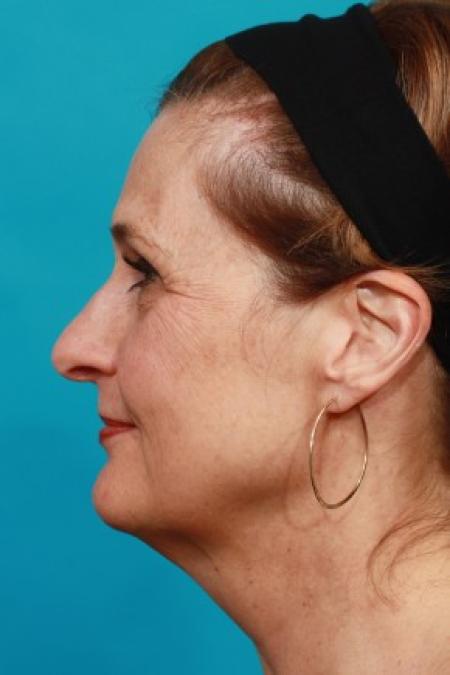 Before image 3 Case #86596 - Full Facial Rejuvenation