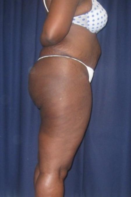 Before Case #82351 - Brazilian Buttock Lift