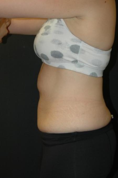 Before Case #81341 - Coolsculpting Procedure on Upper Abdomen