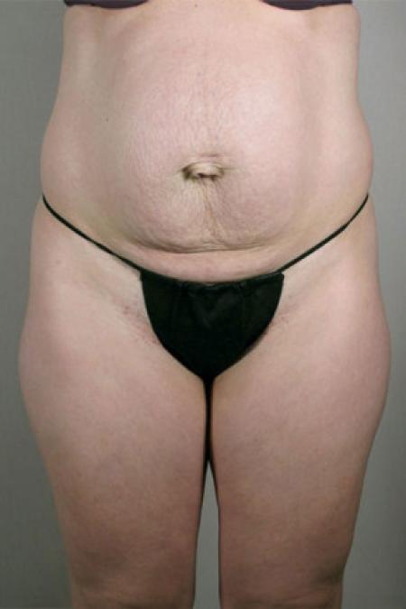 Before image 3 Case #103196 - Mommy Makeover Patient 58