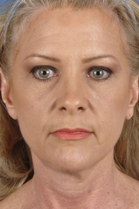 Before image 1 Case #102151 - Neck Lift - 55-year-old woman