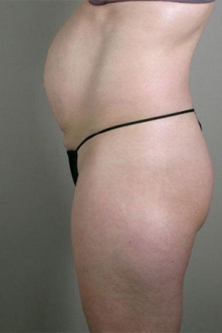 Before image 5 Case #103196 - Mommy Makeover Patient 58