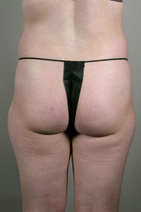 Before image 4 Case #103196 - Mommy Makeover Patient 58