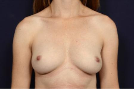 After image 1 Case #103096 - Fat Grafting of Breasts
