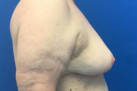 After image 2 Case #103301 - Breast Reduction Mammoplasty for a 70 year old female