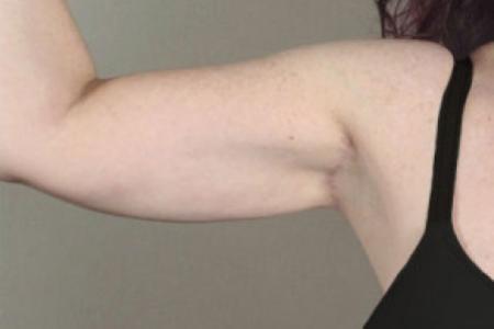 After image 2 Case #103206 - Arm Lift Patient 12