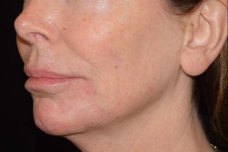 After image 2 Case #105226 - Filler Before & After with Dr. David P. Rapaport
