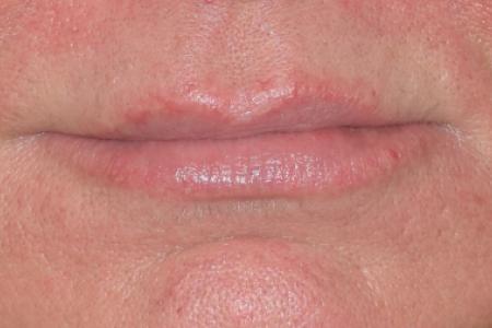 Before image 1 Case #107926 - Restylane® Dermal Fillers