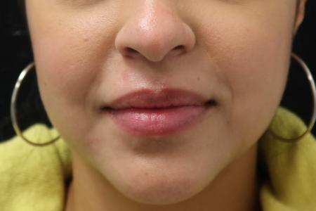 After image 1 Case #107936 - Cosmetic Mole Removal (Nose, Upper Lip & Chin)