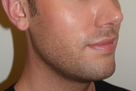 After image 3 Case #107881 - Male Facial Contouring with Morpheus8
