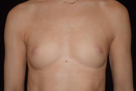 Before image 1 Case #110161 - Endoscopic Breast Augmentation (255cc)