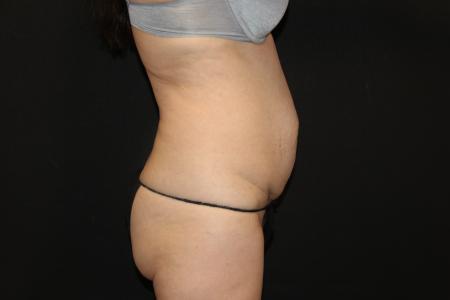 Before image 3 Case #115486 - Abdominoplasty