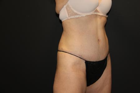 After image 2 Case #115486 - Abdominoplasty