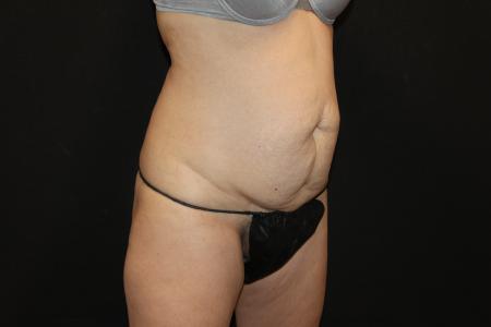 Before image 2 Case #115486 - Abdominoplasty