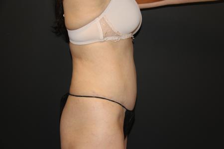 After image 3 Case #115486 - Abdominoplasty