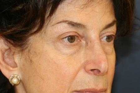 Before image 2 Case #117511 - Eyelid Rejuvenation