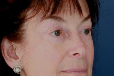 After image 2 Case #117511 - Eyelid Rejuvenation