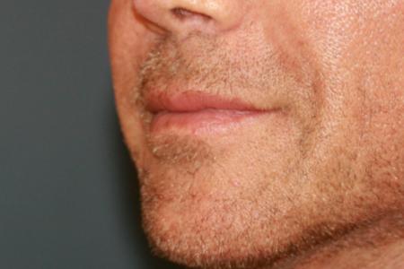 Before image 2 Case #118701 - Male Upper Lip Lift