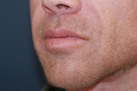After image 2 Case #118701 - Male Upper Lip Lift