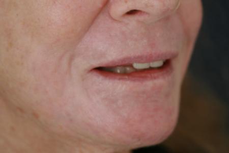 After image 2 Case #119171 - Peri-oral Co2 Laser Resurfacing