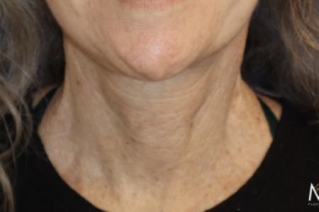 After image 2 Case #119161 - 65 year-old Patient | Neck Lift
