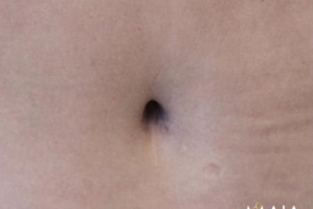 After image 6 Case #119131 - 53 year-old Patient | Mommy Makeover