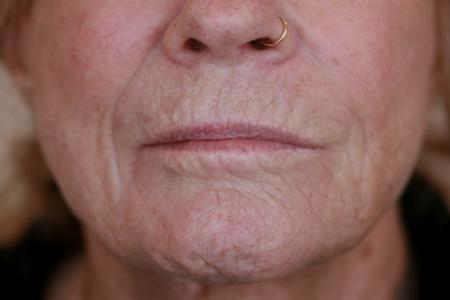 Before image 1 Case #119171 - Peri-oral Co2 Laser Resurfacing