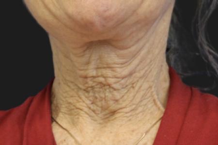 Before image 2 Case #119161 - 65 year-old Patient | Neck Lift