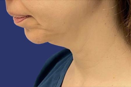 Before Case #119361 - 43 year-old Patient | Neck Lift
