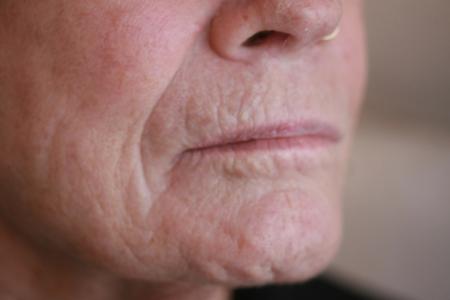 Before image 2 Case #119171 - Peri-oral Co2 Laser Resurfacing